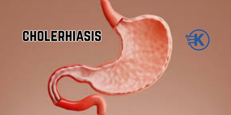 cholerhiasis
